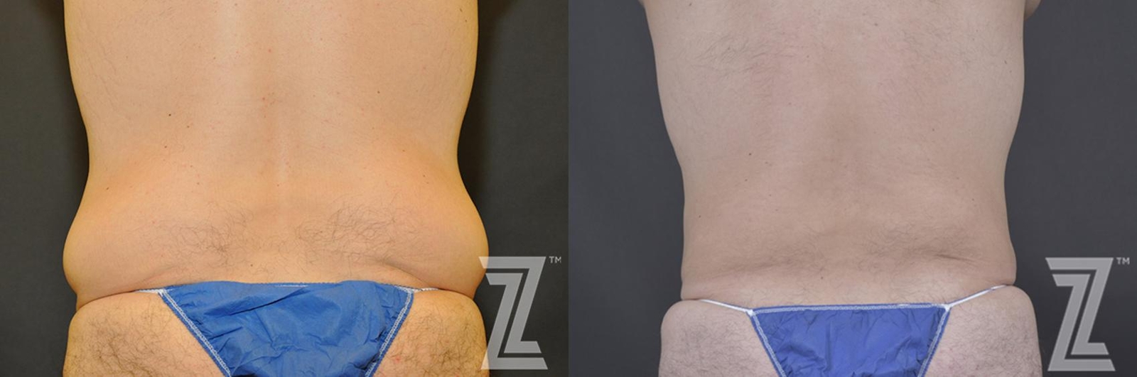 Austin Tummy Tuck Before & After Gallery - Patient 132886870 - Image 4 - The Piazza Center