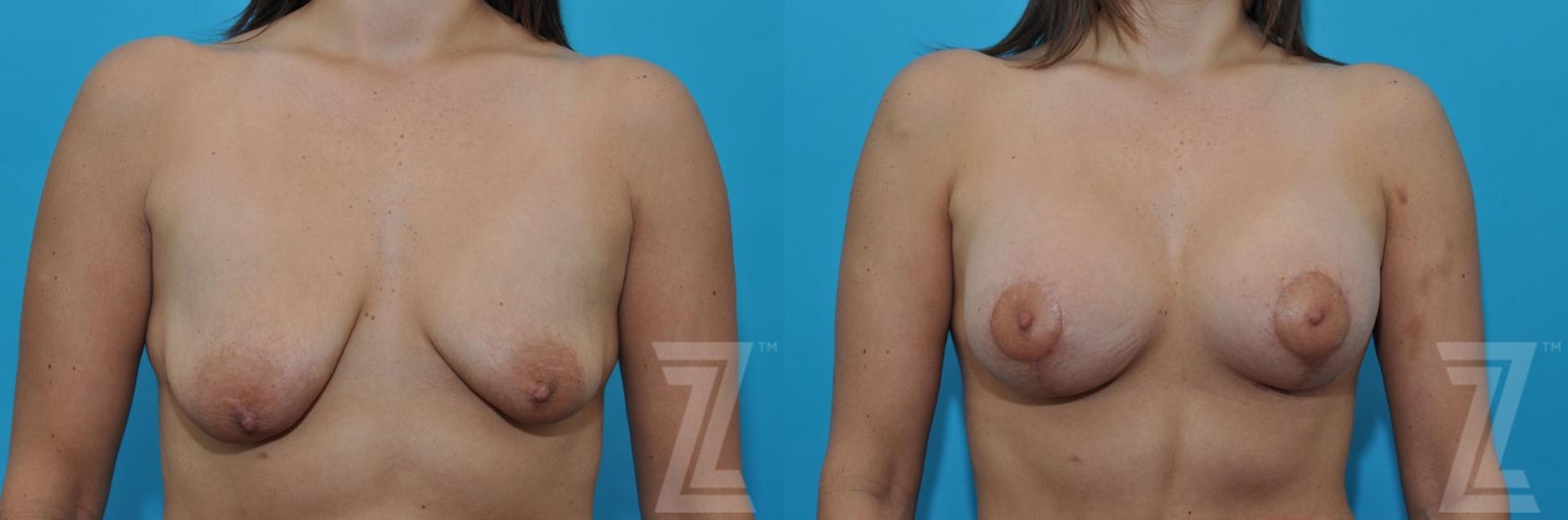 Austin Breast Augmentation With a Breast Lift Before & After Gallery - Patient 132791109 - Image 1 - The Piazza Center
