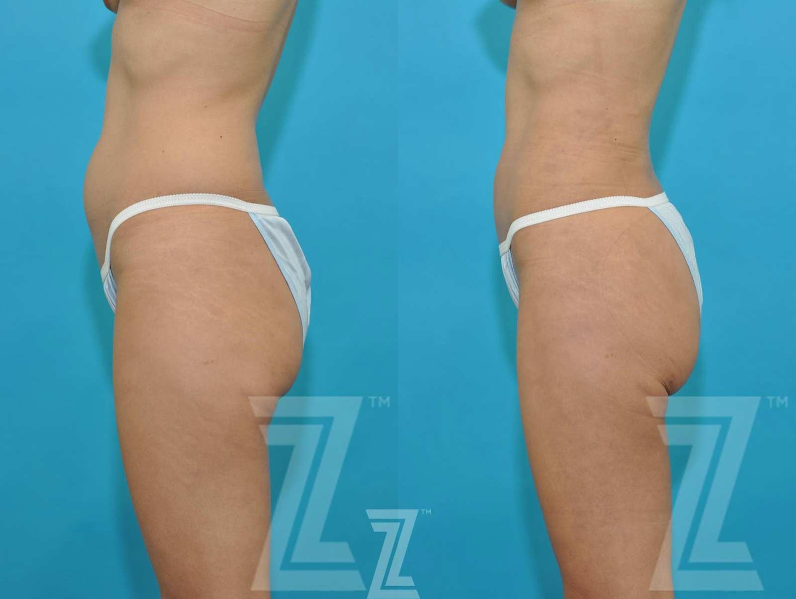 Austin Liposuction Before & After Gallery - Patient 132893822 - Image 2 - The Piazza Center