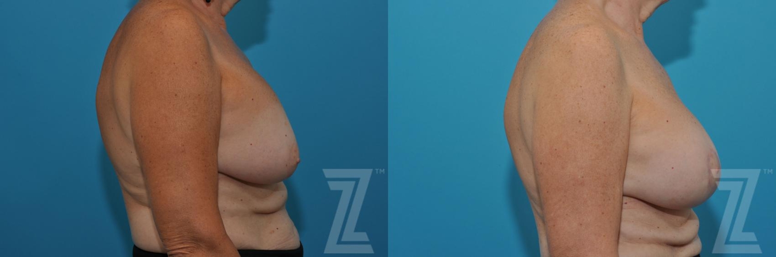 Austin Breast Augmentation Revision Before & After Gallery - Patient 132886586 - Image 5 - The Piazza Center