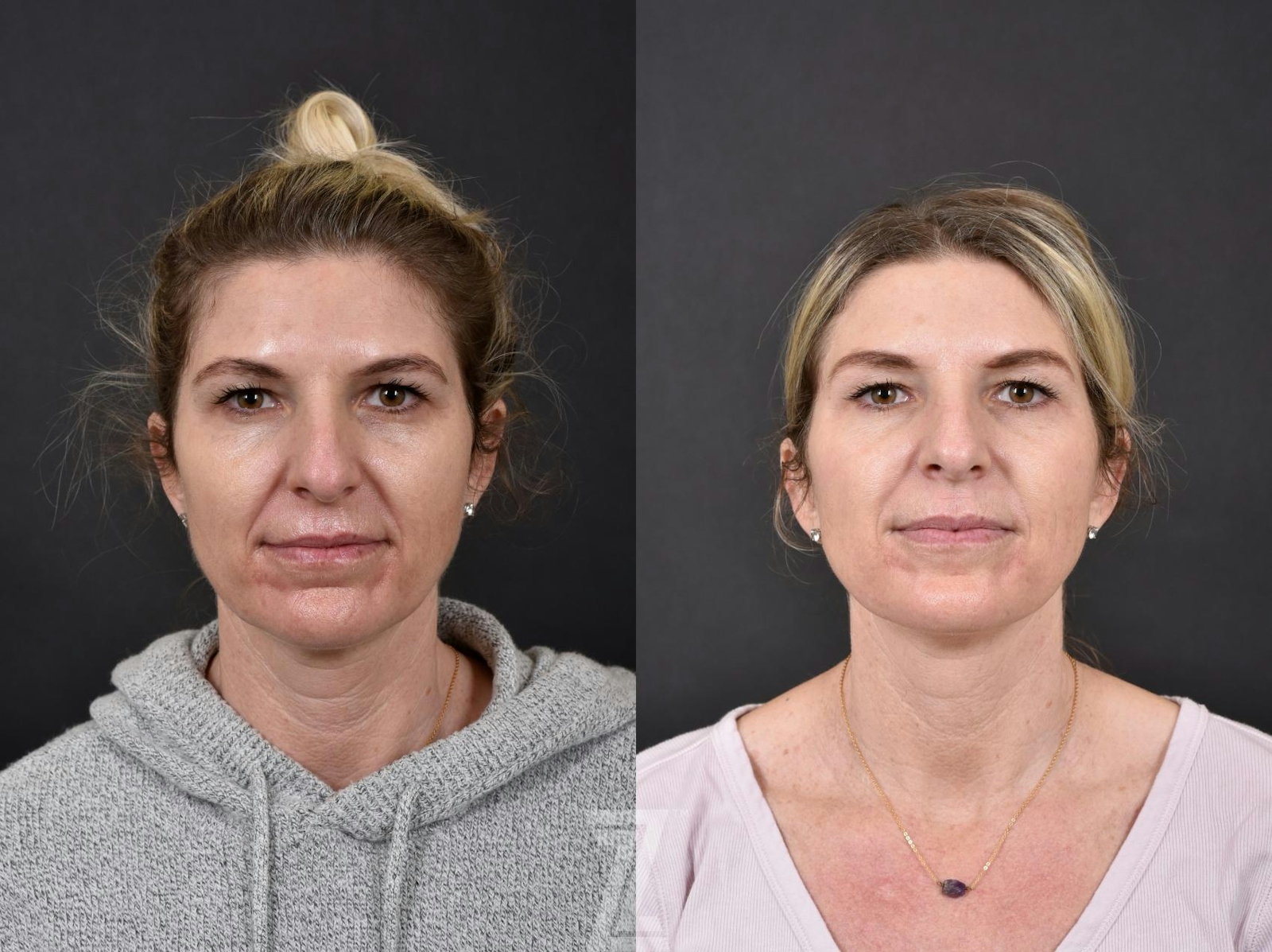 Austin Wrinkle Relaxers Before & After Gallery - Patient 132906304 - Image 1 - The Piazza Center