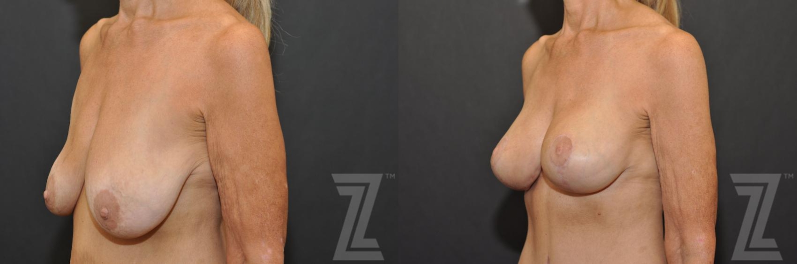 Austin Breast Augmentation With a Breast Lift Before & After Gallery - Patient 132793339 - Image 2 - The Piazza Center