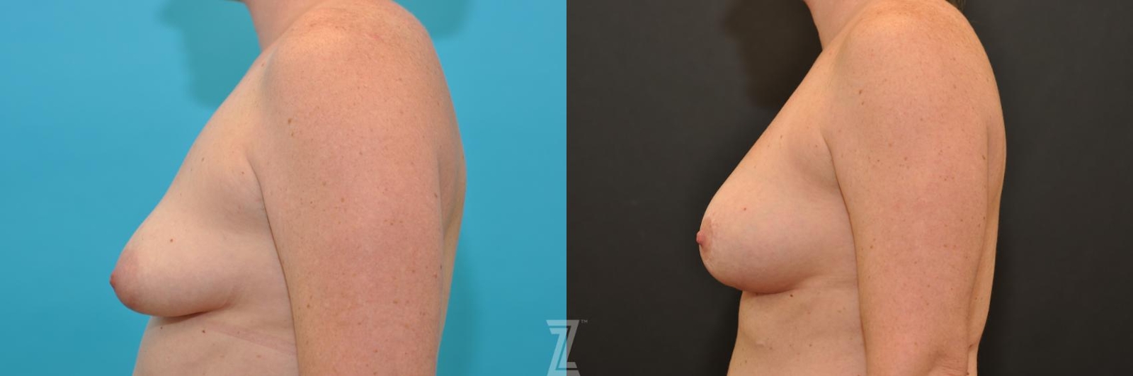 Austin Breast Augmentation With a Breast Lift Before & After Gallery - Patient 132791097 - Image 3 - The Piazza Center
