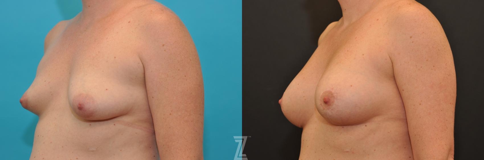 Austin Breast Augmentation With a Breast Lift Before & After Gallery - Patient 132791097 - Image 2 - The Piazza Center