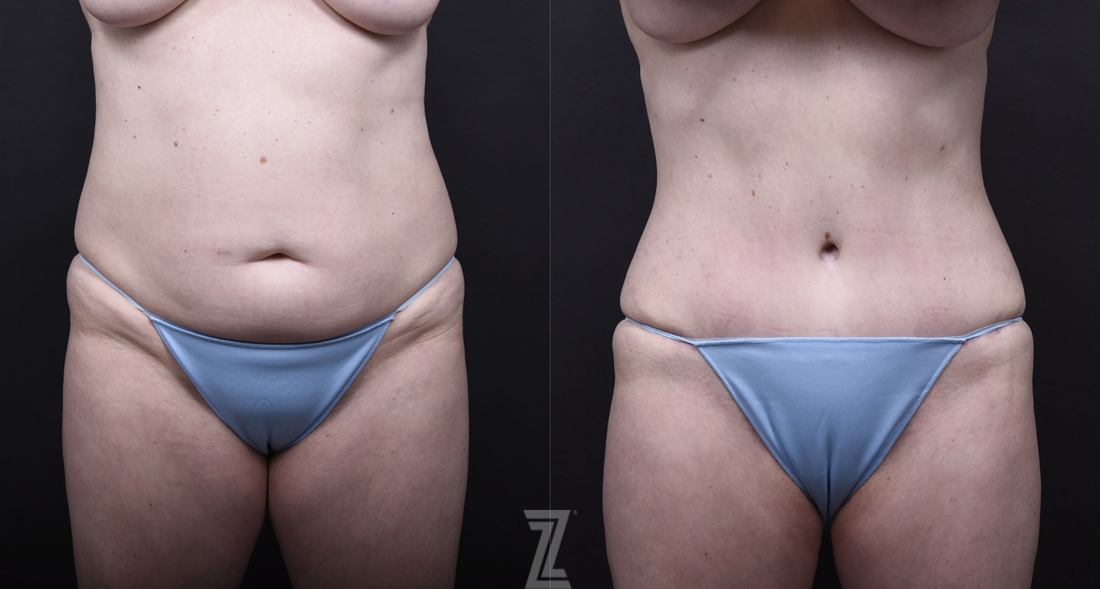 Austin Mommy Makeover Before & After Gallery - Patient 105405 - Image 1 - The Piazza Center