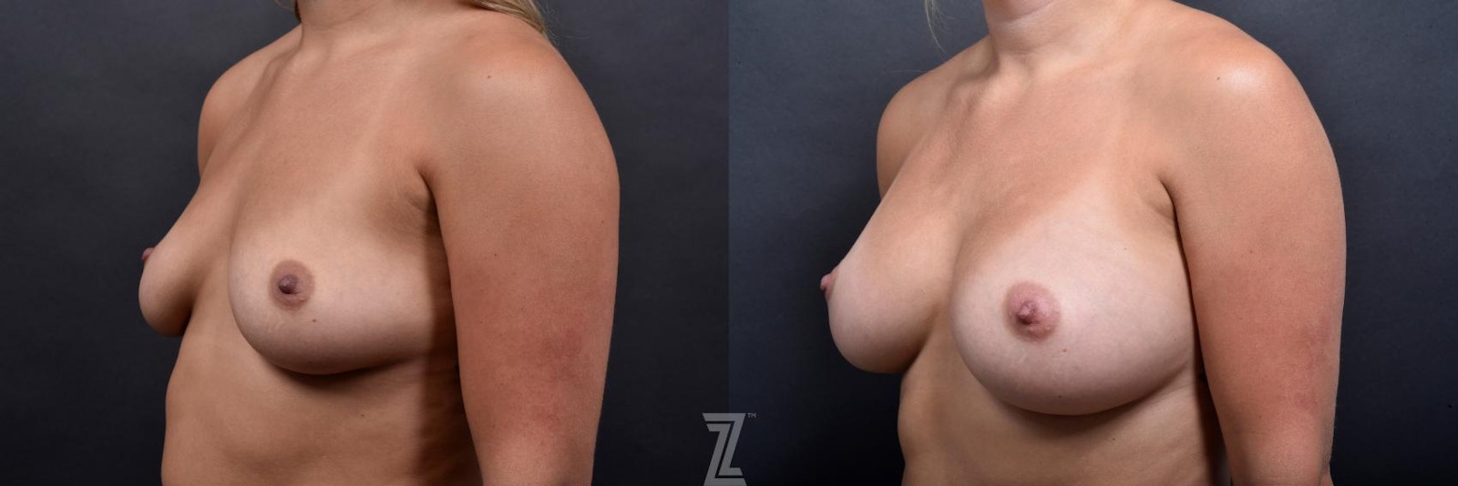 Austin oblique view Before and after image of 27 year old woman with breast augmentation - Dr. Rocco C. Piazza - The Piazza Center
