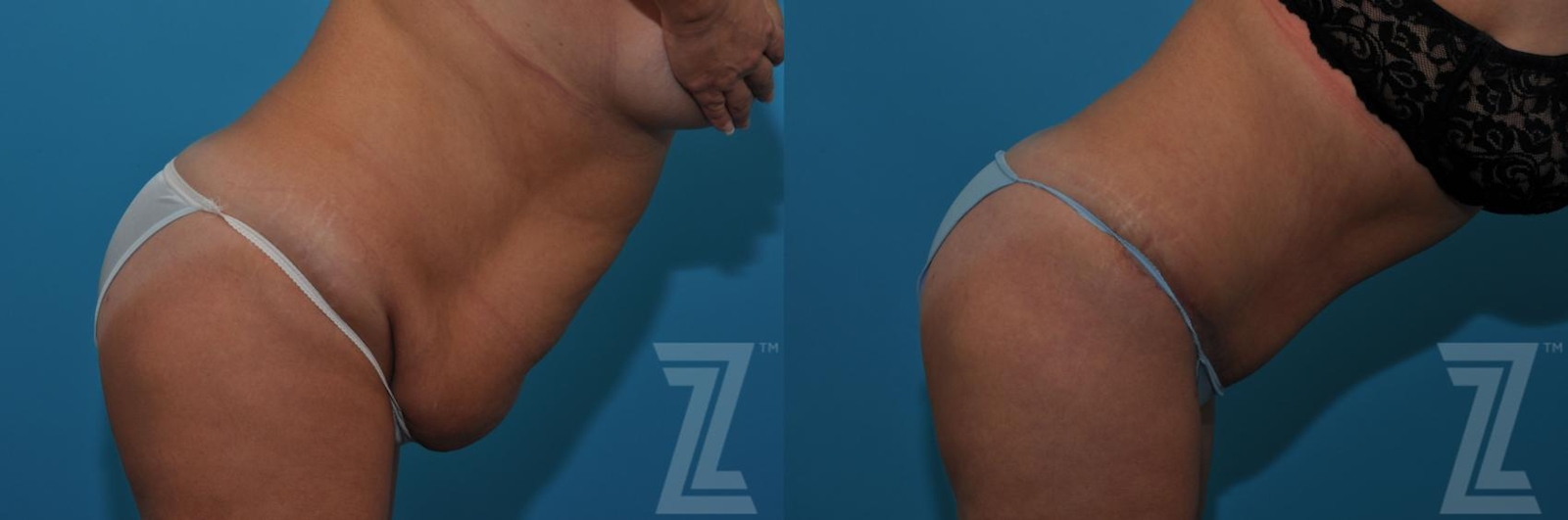Austin Tummy Tuck Before & After Gallery - Patient 132886809 - Image 5 - The Piazza Center