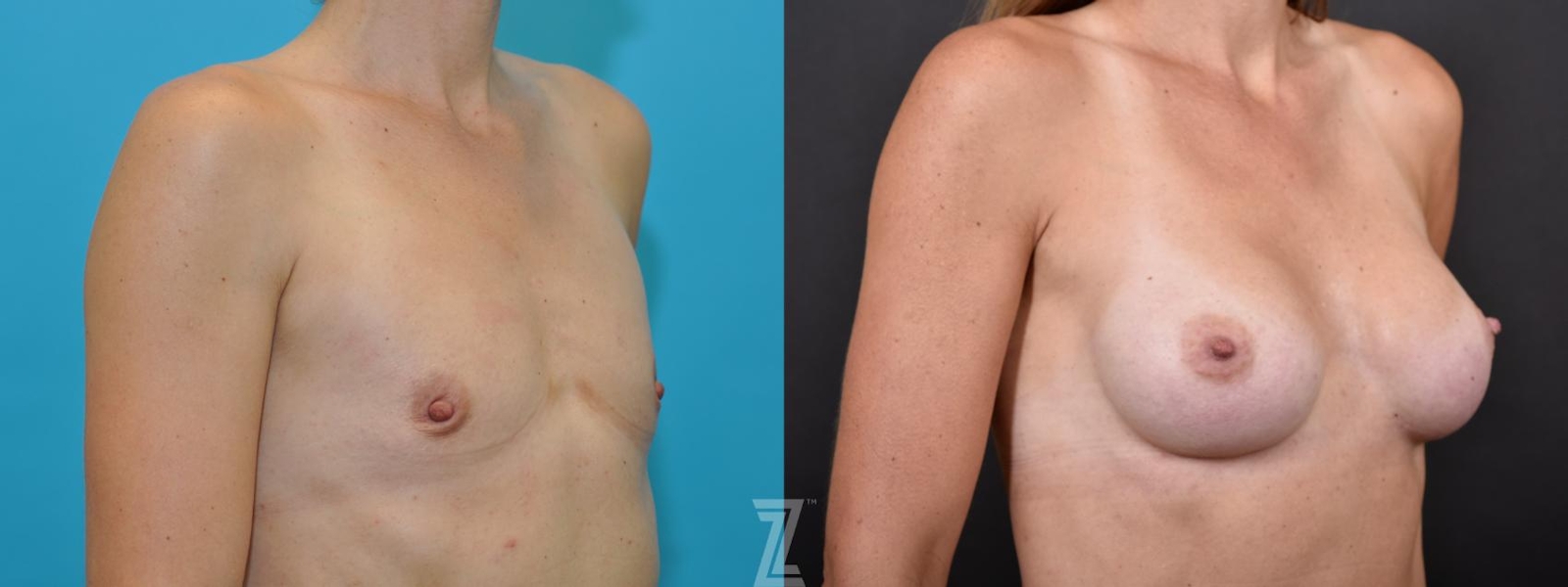 Austin Oblqiue view Before and After 5 year post op of Silicone Implants with Highly Cohesive Gel (Gummy Bear Implants) - The Piazza Center