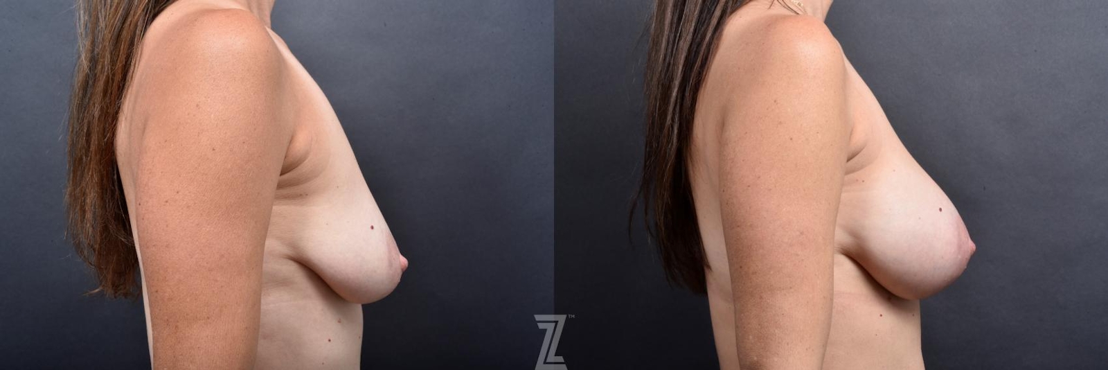 Austin Side view before & after of 43 year old woman 6 month post op breast augmentation - The Piazza Center - The Piazza Center