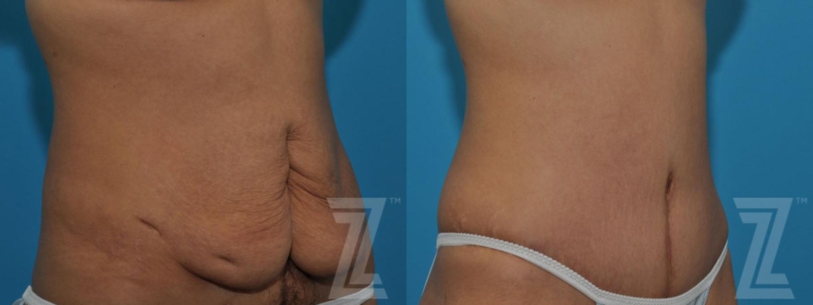 Austin Tummy Tuck Before & After Gallery - Patient 132886797 - Image 4 - The Piazza Center