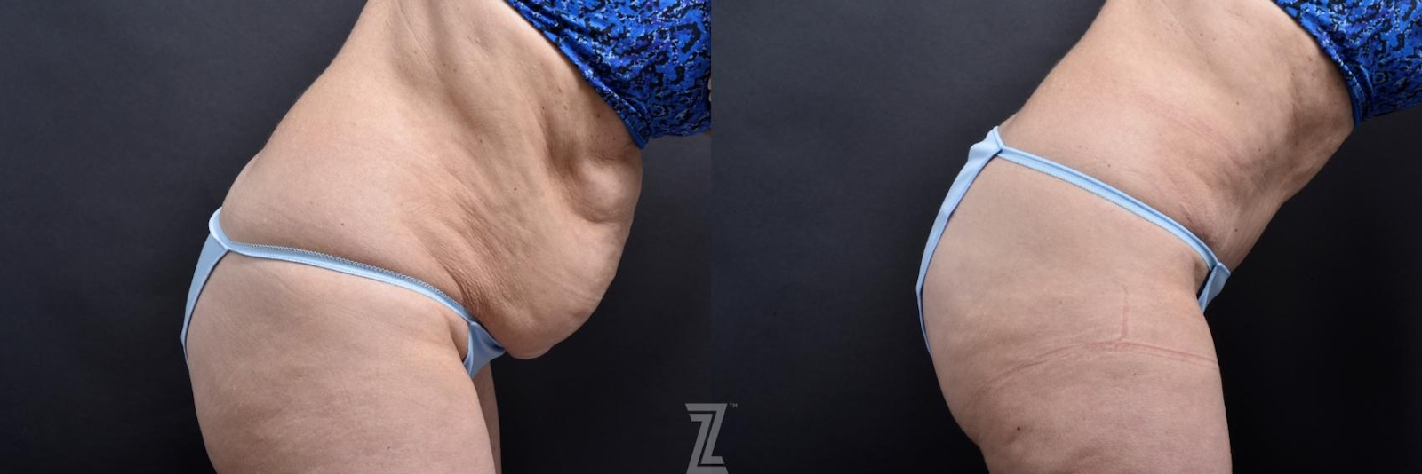 Austin Tummy Tuck Before & After Gallery - Patient 132886818 - Image 5 - The Piazza Center