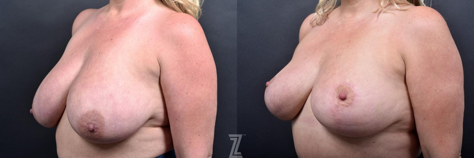 Austin Breast Reduction Before & After Gallery - Patient 132886609 - Image 2 - The Piazza Center
