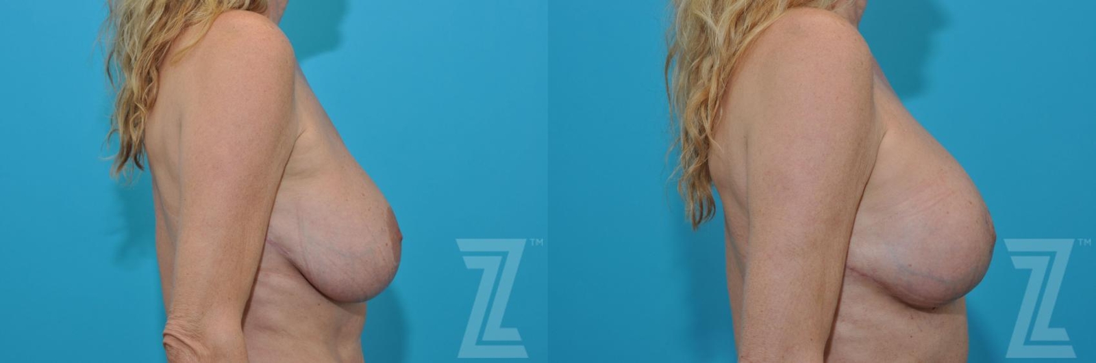 Austin Breast Augmentation Revision Before & After Gallery - Patient 132886579 - Image 5 - The Piazza Center