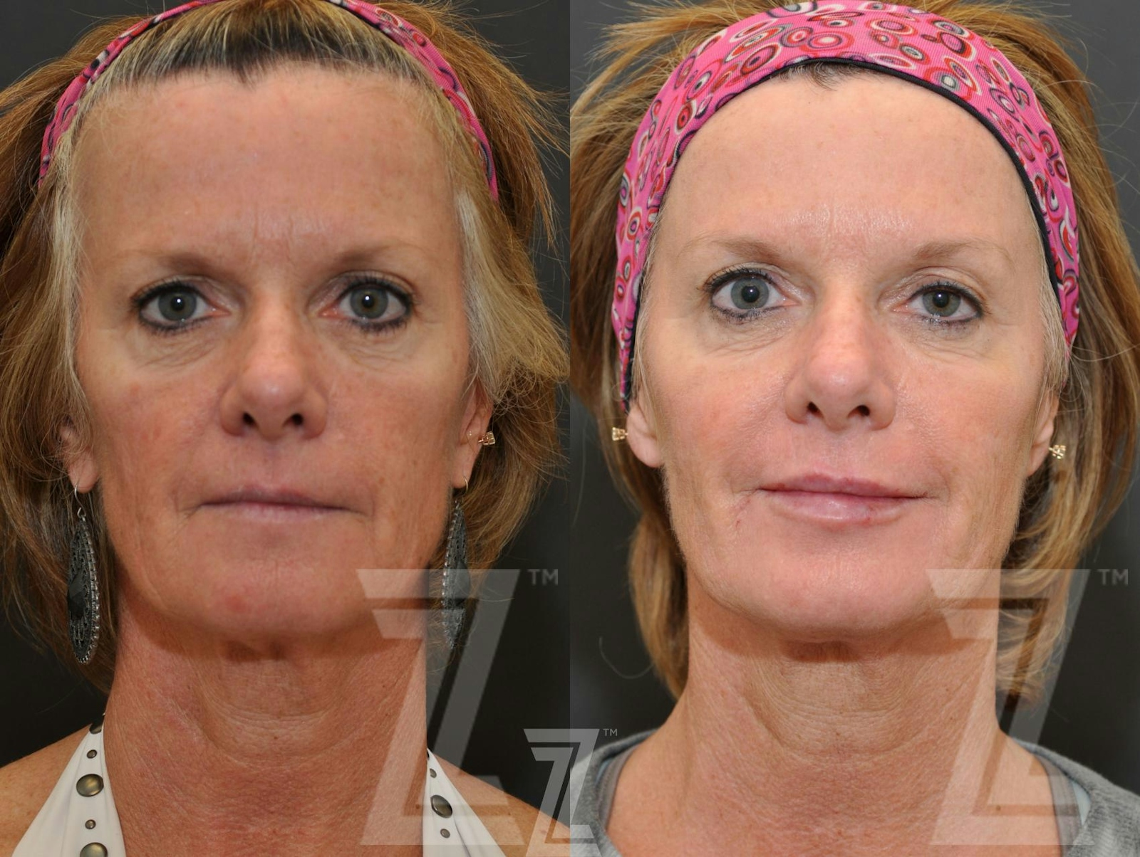 Austin Injectable Fillers Before & After Gallery - Patient 132963114 - Image 1 - The Piazza Center