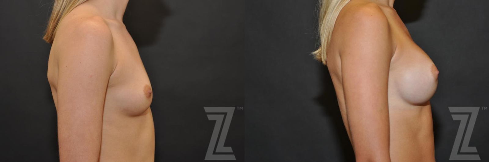 Austin lateral view of 27 year old woman before and after breast augmentation - The Piazza Center