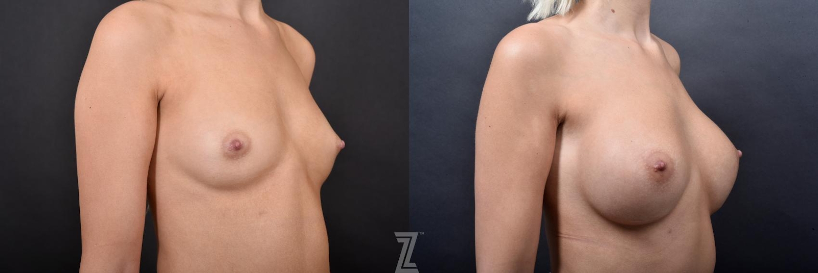 Austin Oblique before and after images of Silicone Implants with Cohesive Silicone Gel on 27 year old woman at the piazza center - The Piazza Center