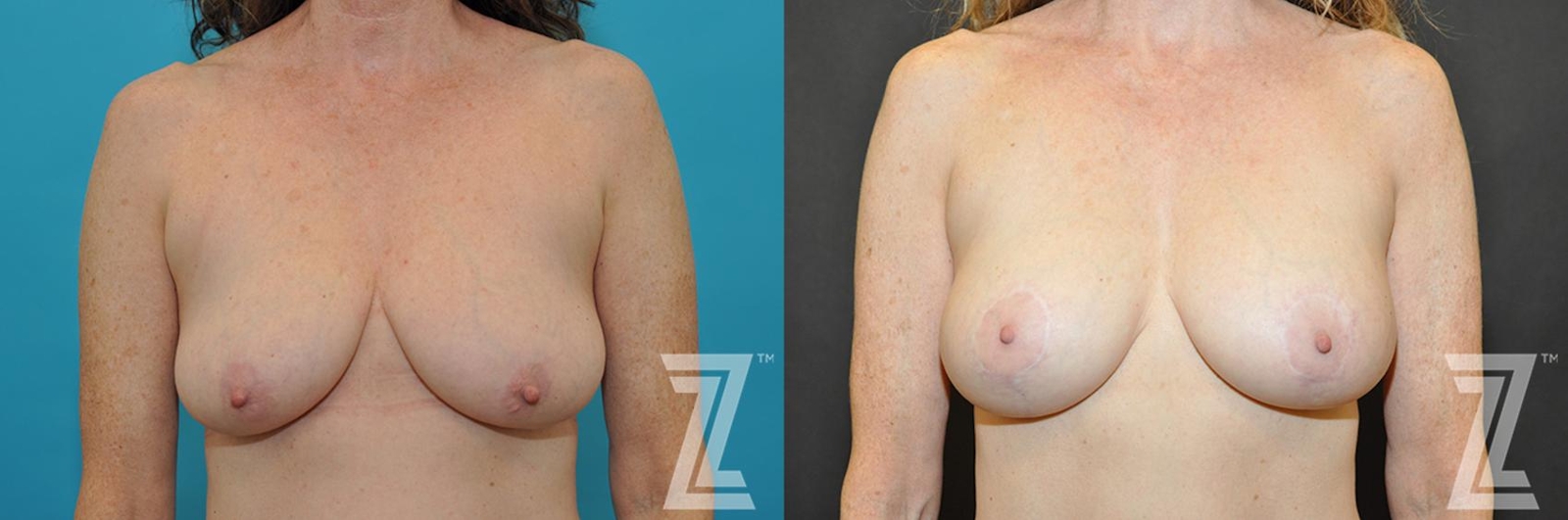 Austin Breast Augmentation With a Breast Lift Before & After Gallery - Patient 132791131 - Image 1 - The Piazza Center