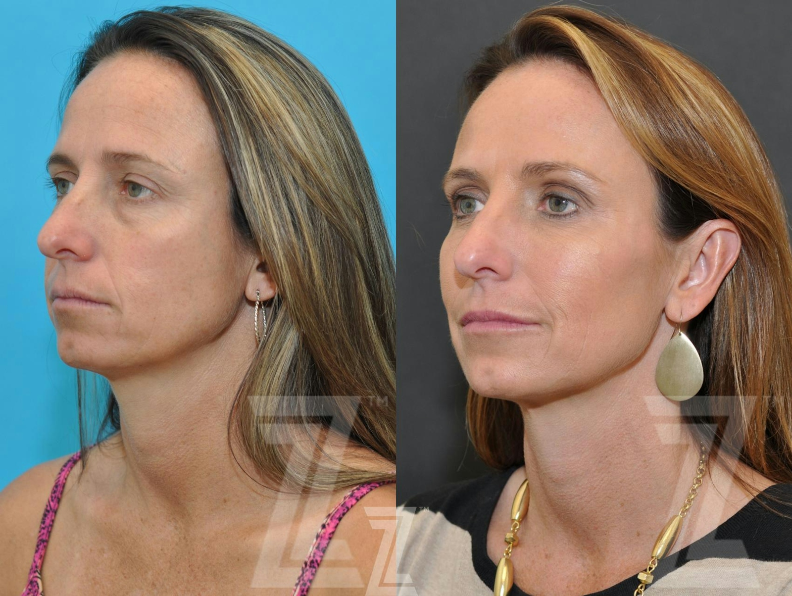 Austin Injectable Fillers Before & After Gallery - Patient 132963121 - Image 2 - The Piazza Center
