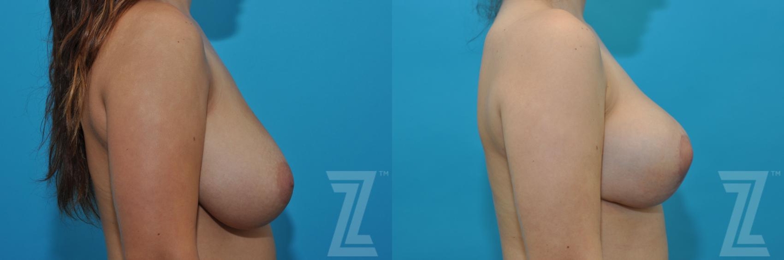 Austin Breast Reduction Before & After Gallery - Patient 132886608 - Image 5 - The Piazza Center