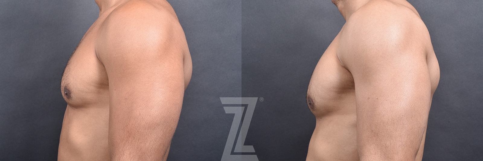 Austin Gynecomastia/Male Breast Reduction Before & After Gallery - Patient 377773 - Image 4 - The Piazza Center