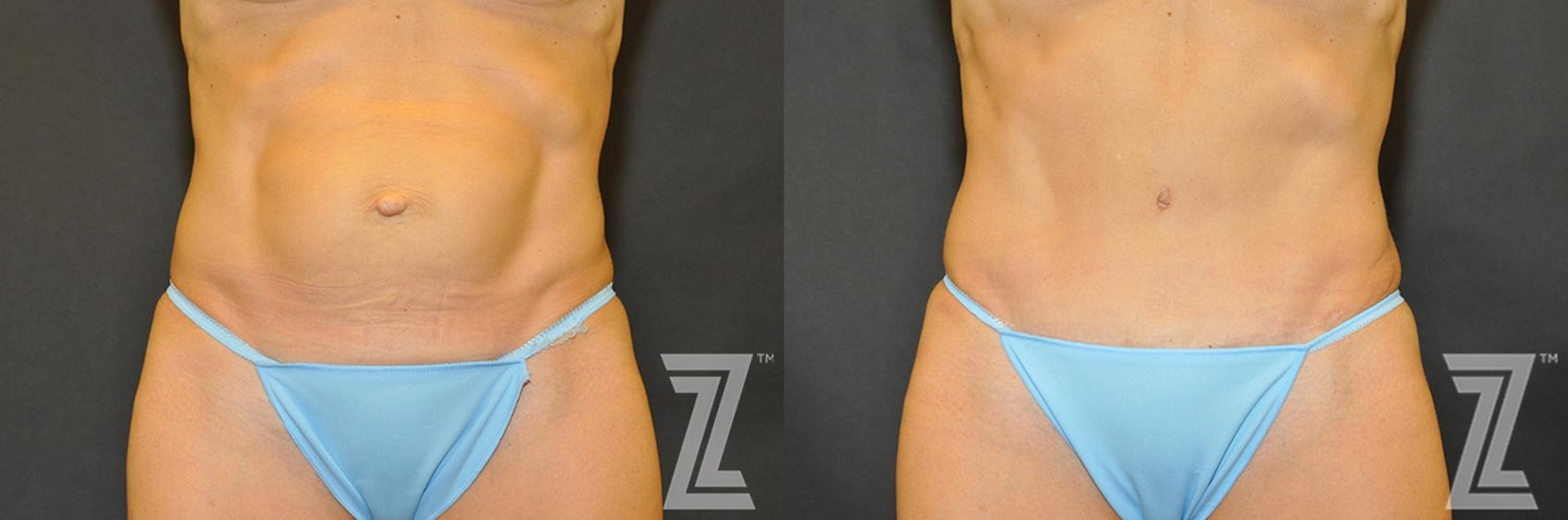 Austin Tummy Tuck Before & After Gallery - Patient 132886866 - Image 1 - The Piazza Center