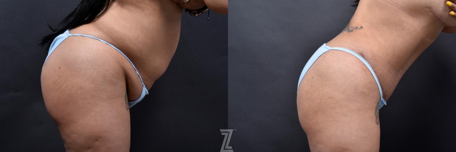 Austin 6 Month Post-OP Mommy Makeover in Austin, TX by Dr. Rocco Piazza - Lateral Abdomen View in Flexion - The Piazza Center