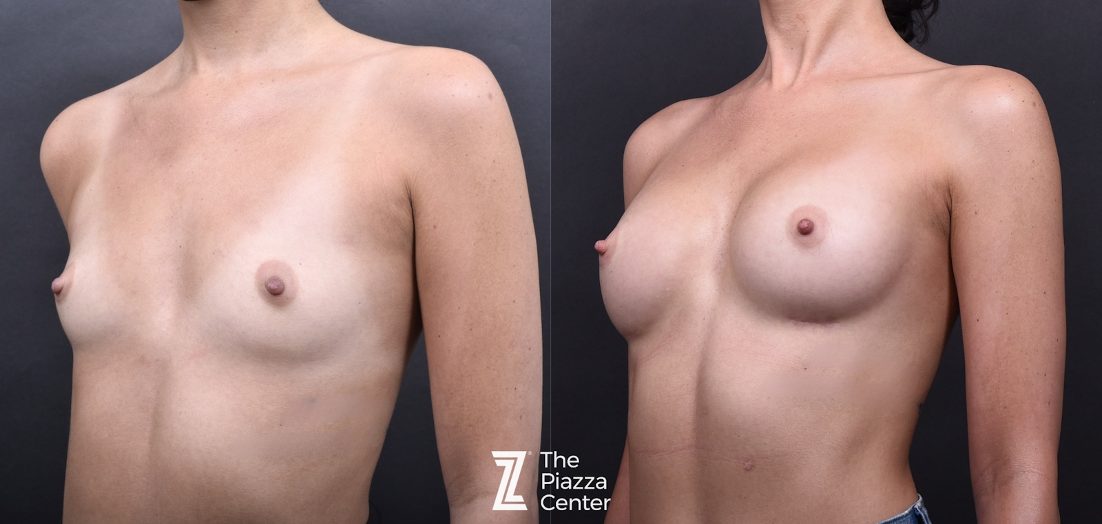Austin Breast Augmentation Before & After Gallery - Patient 790705 - Image 4 - The Piazza Center