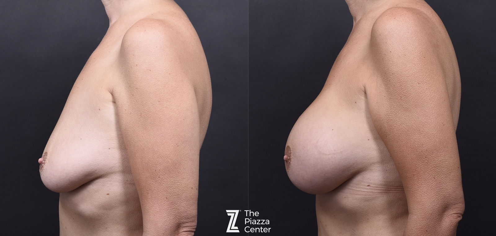 Austin Breast Augmentation Before & After Gallery - Patient 345874 - Image 5 - The Piazza Center