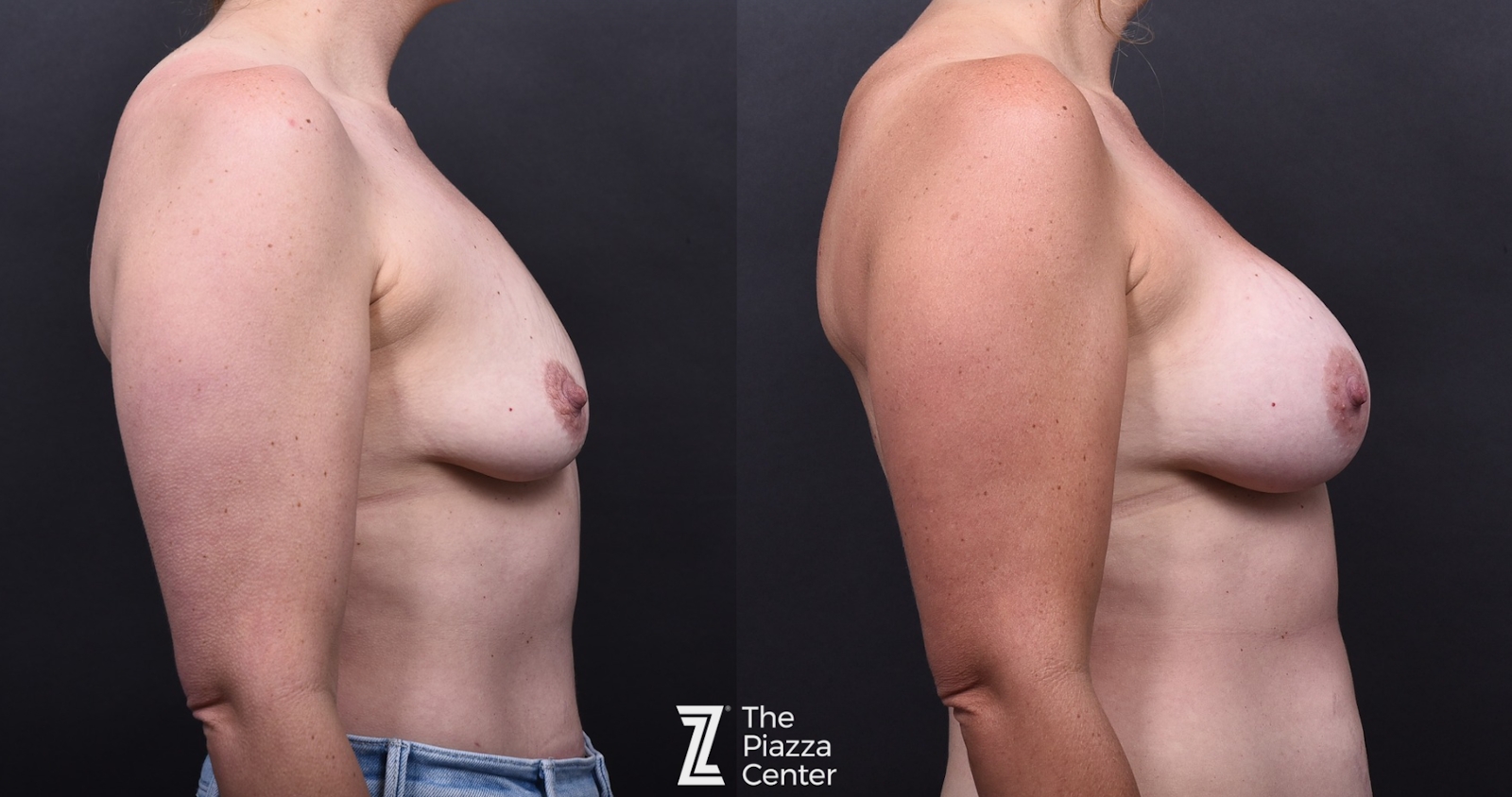 Austin Breast Augmentation Before & After Gallery - Patient 353034 - Image 3 - The Piazza Center