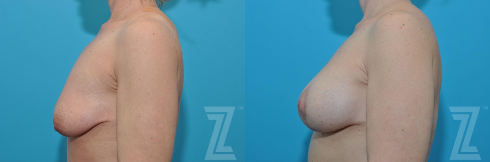 Austin Breast Augmentation With a Breast Lift Before & After Gallery - Patient 132791127 - Image 3 - The Piazza Center