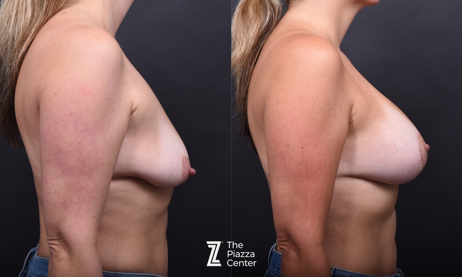 Austin Breast Augmentation Before & After Gallery - Patient 730444 - Image 3 - The Piazza Center