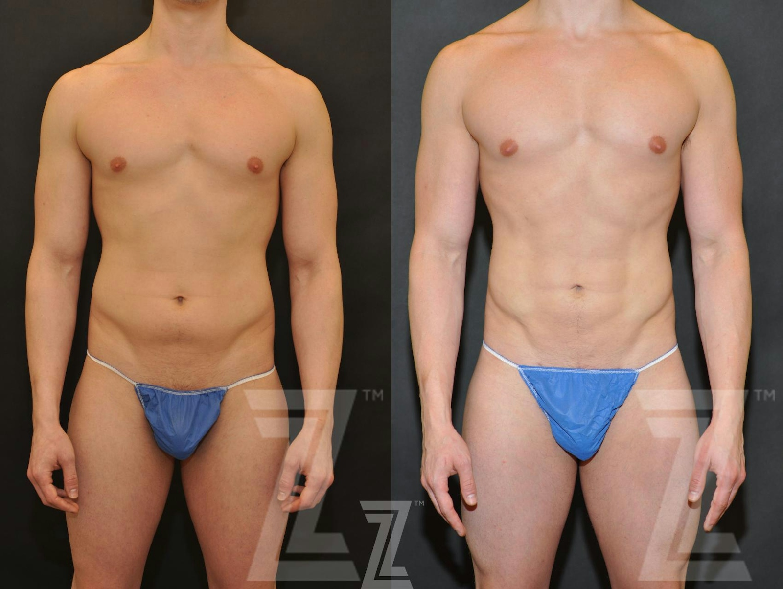 Austin Male Body Contouring Before & After Gallery - Patient 174118 - Image 1 - The Piazza Center