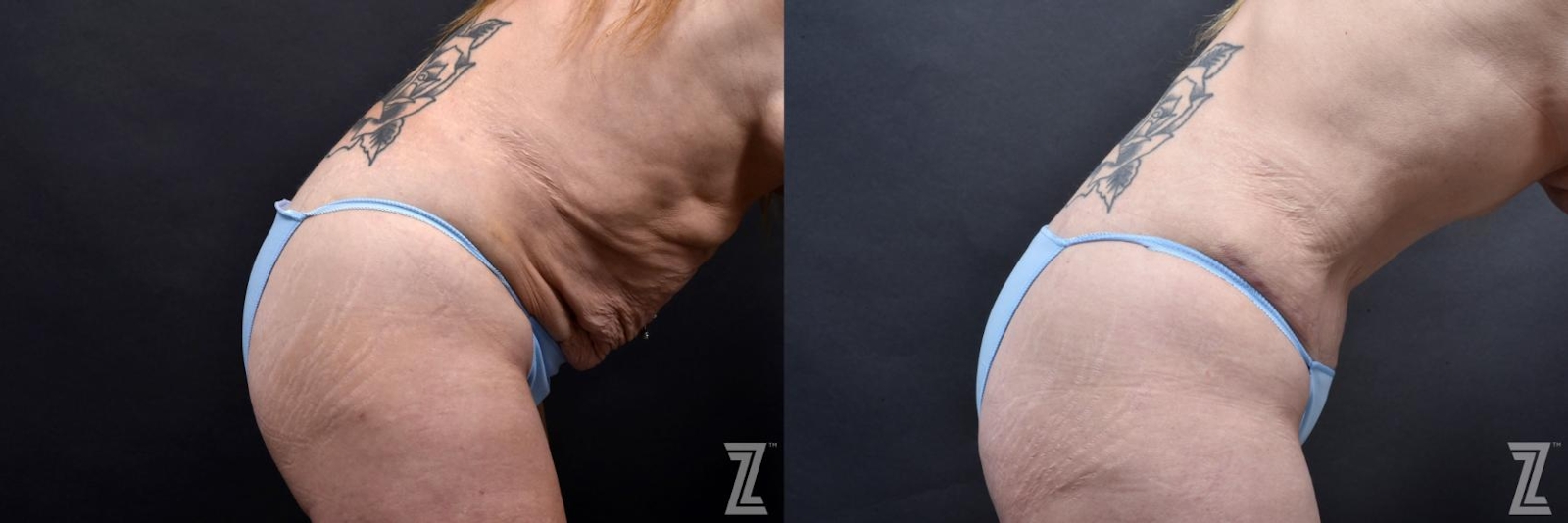 Austin Tummy Tuck Before & After Gallery - Patient 132886812 - Image 5 - The Piazza Center
