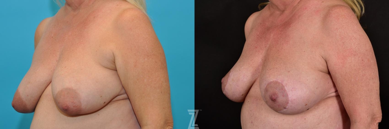 Austin Breast Lift Before & After Gallery - Patient 132791071 - Image 2 - The Piazza Center