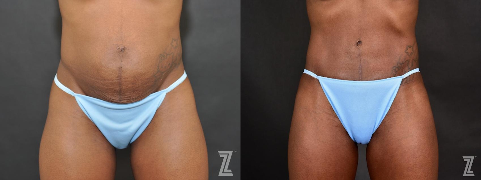 Austin Tummy Tuck Before & After Gallery - Patient 132886804 - Image 1 - The Piazza Center