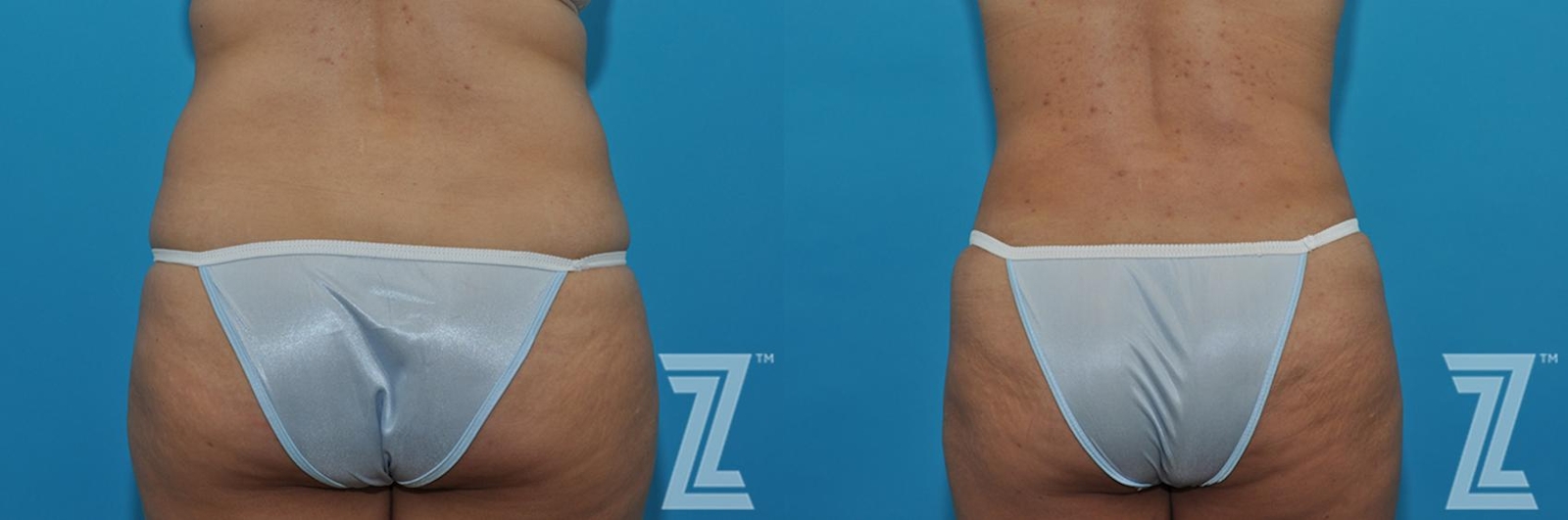 Austin Tummy Tuck Before & After Gallery - Patient 132886863 - Image 2 - The Piazza Center