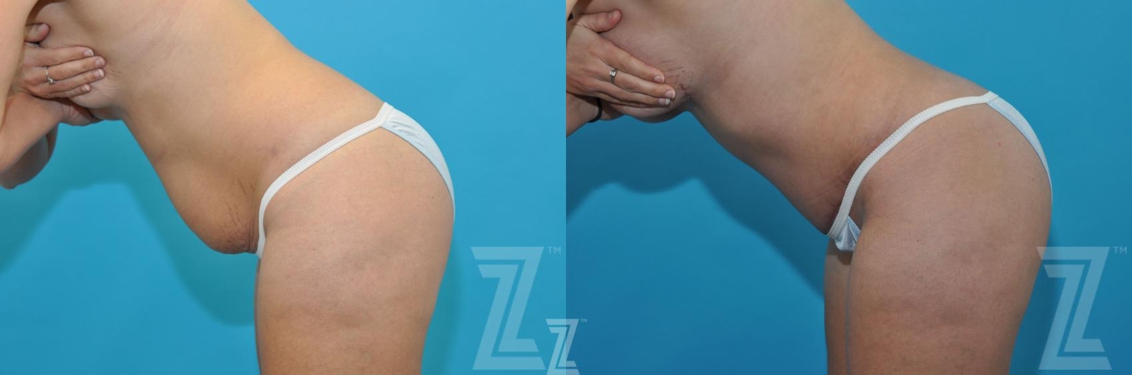 Austin Before & After images oblique flexion view of 40-year-old mother of five mommy maker over - Dr. Rocco Piazza, Austin TX - The Piazza Center