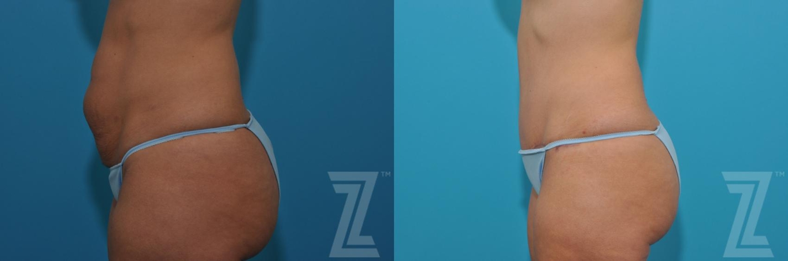 Austin Tummy Tuck Before & After Gallery - Patient 132886876 - Image 2 - The Piazza Center