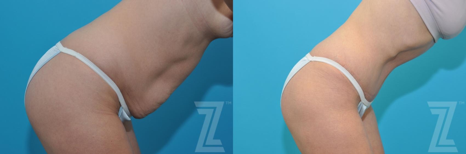 Austin Tummy Tuck Before & After Gallery - Patient 132886905 - Image 5 - The Piazza Center