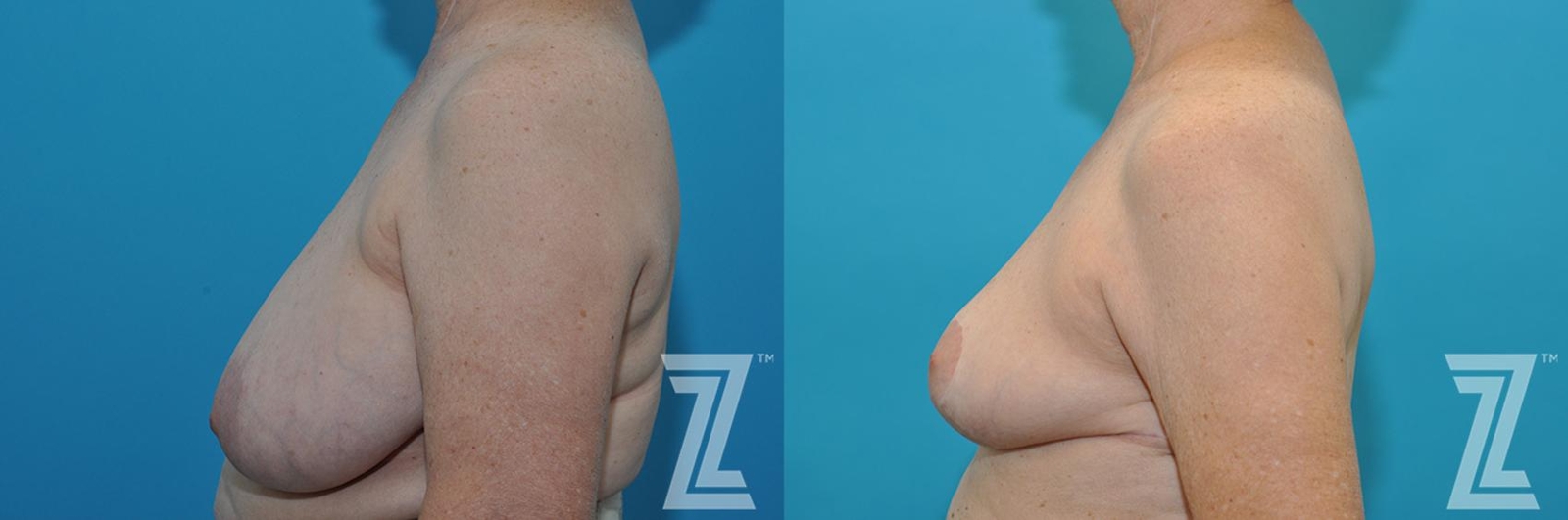 Austin Correction of Breast Asymmetry Before & After Gallery - Patient 132886776 - Image 3 - The Piazza Center