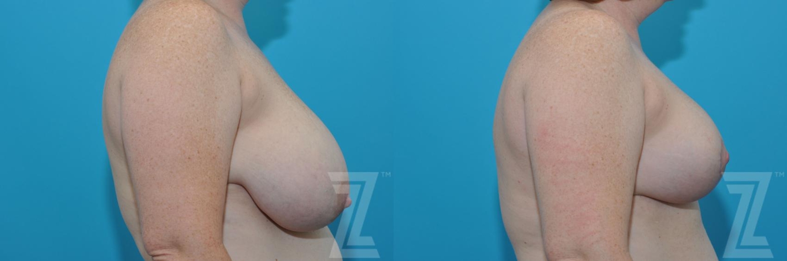 Austin Breast Reduction Before & After Gallery - Patient 132886606 - Image 5 - The Piazza Center