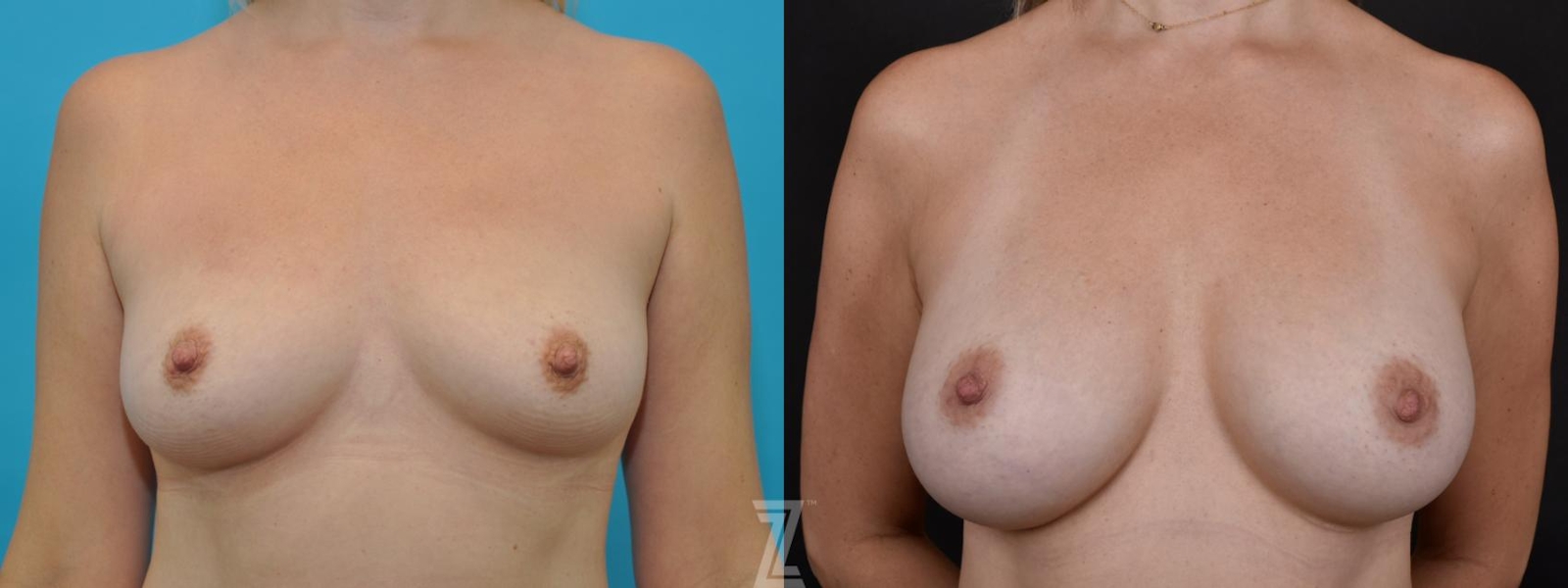 Austin 5 year post op frontal view before & after images of 35 year old woman with Silicone Implants with Highly Cohesive Gel (Gummy Bear Implants) - The Piazza Center