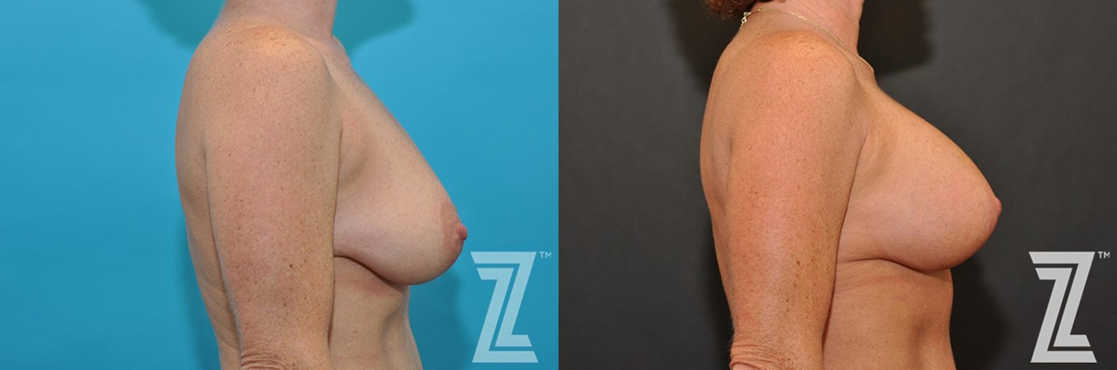 Austin Breast Augmentation With a Breast Lift Before & After Gallery - Patient 132791107 - Image 5 - The Piazza Center