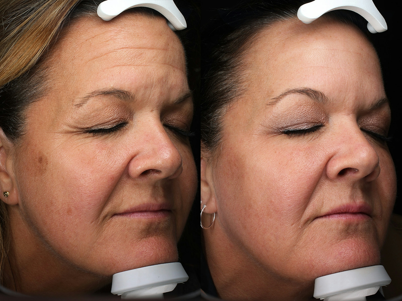 Austin BBL Before & After Gallery - Patient 940109 - Image 2 - The Piazza Center