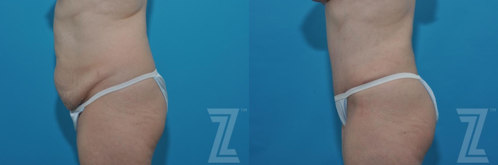 Austin Tummy Tuck Before & After Gallery - Patient 132886813 - Image 2 - The Piazza Center