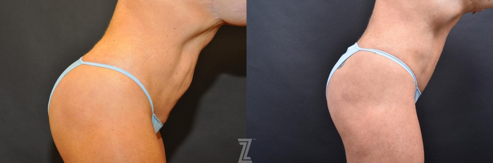 Austin Skin Pinch Before & After Gallery - Patient 132886906 - Image 5 - The Piazza Center