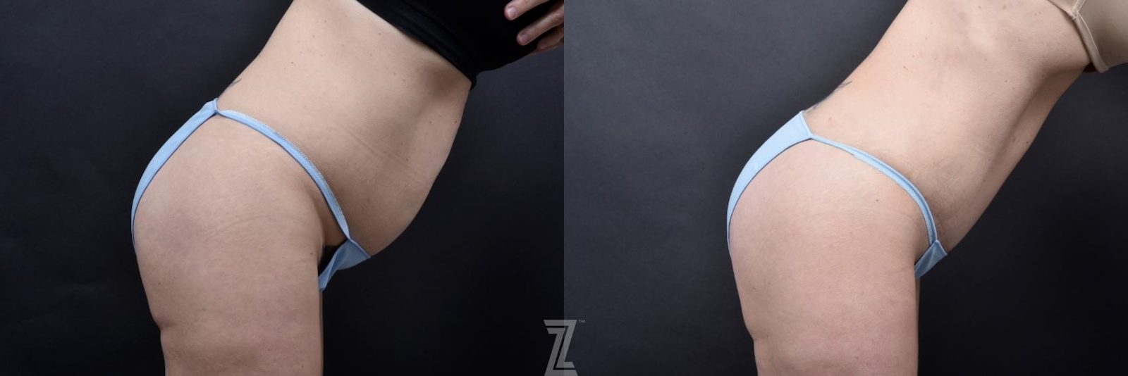 Austin Tummy Tuck Before & After Gallery - Patient 132886820 - Image 5 - The Piazza Center