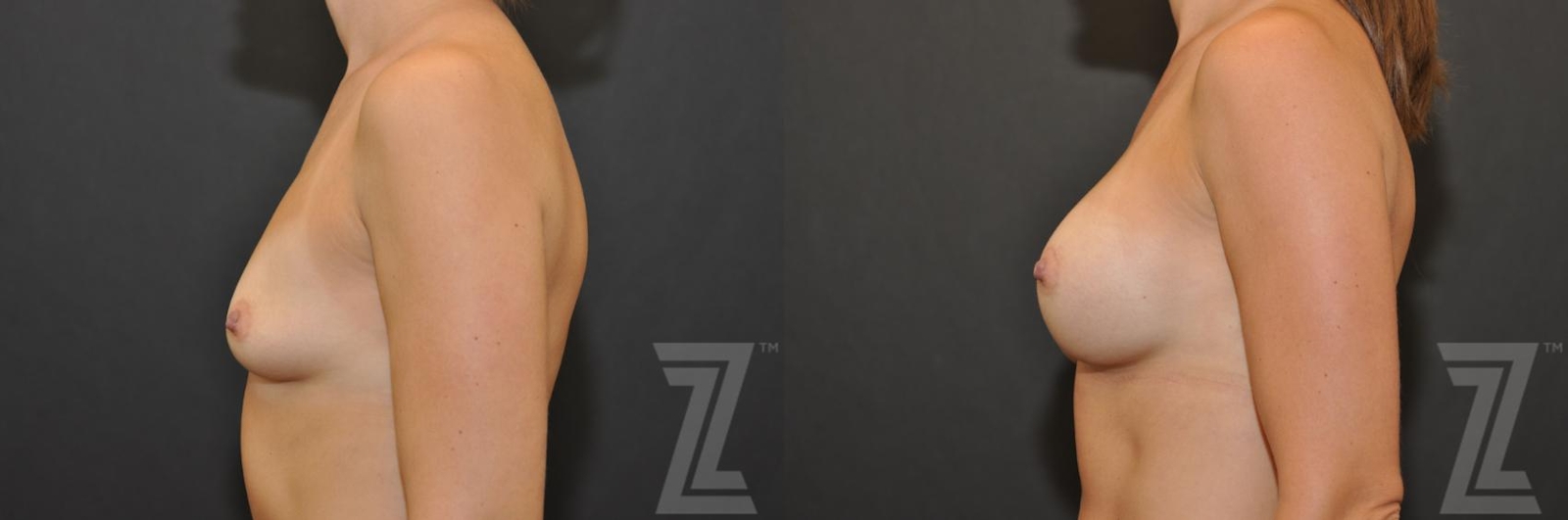 Austin Side view before & after images of 32-year-old mother of two 6 month post op breast augmentation - The Piazza Center - The Piazza Center