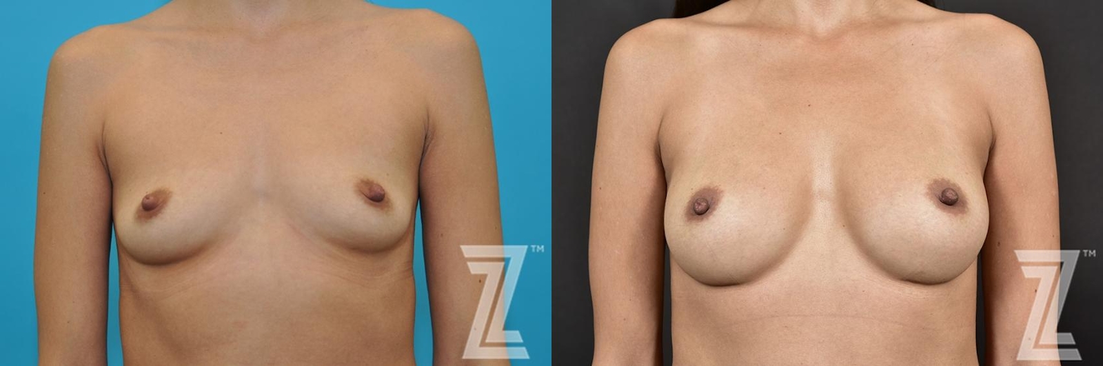 Austin Bilateral View Before & After Breast Augmentation of 32-Year-Old Female Patient With Silicone Implants with Cohesive Silicone Gel - The Piazza Center