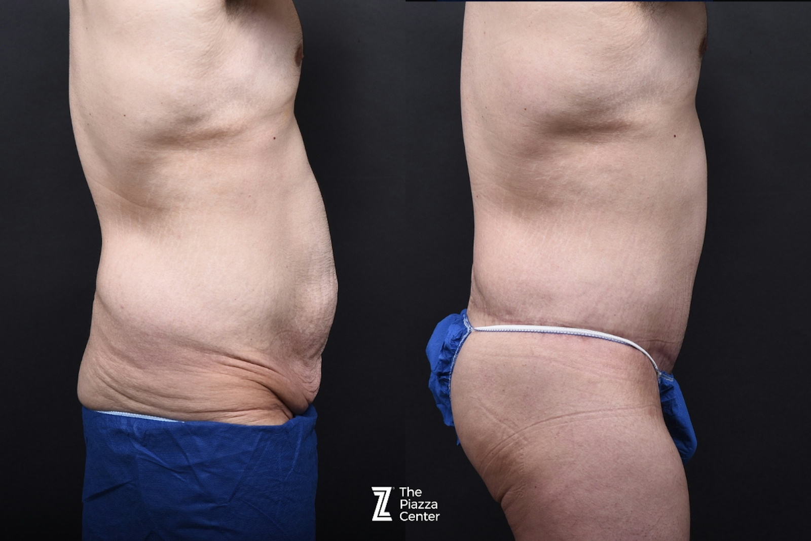 Austin Tummy Tuck Before & After Gallery - Patient 346471 - Image 2 - The Piazza Center